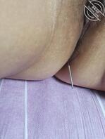 在熟女骚逼里面扎针艾灸1