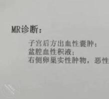 陪酒骚妈卵巢癌晚期，还有几个月，还有人玩吗0