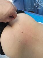 北京微胖女生针灸1