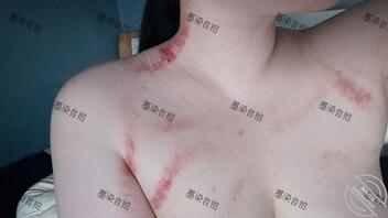 刮了个痧好像经历了什么不得了的事情0