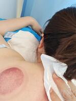 白净的美女拔罐1